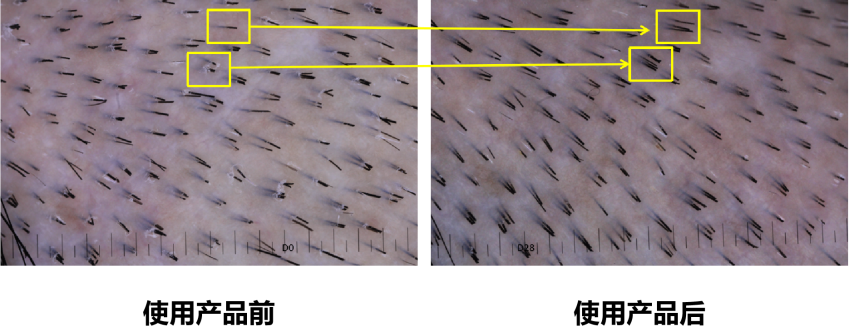 头皮健康,红斑,,丘疹,脓疱,评价方法