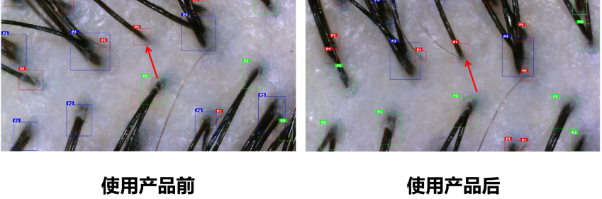 头皮健康,红斑,,丘疹,脓疱,评价方法