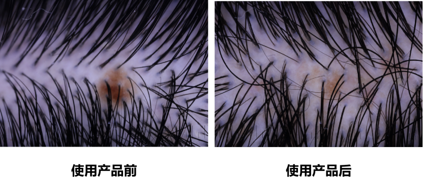 头皮健康,红斑,,丘疹,脓疱,评价方法