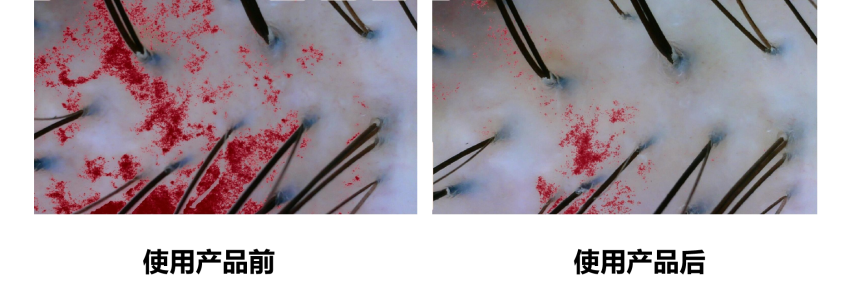 头皮健康,红斑,,丘疹,脓疱,评价方法